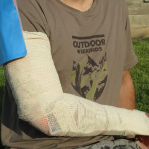 Dlaha horní končetiny s využitím SAM splint dlahy